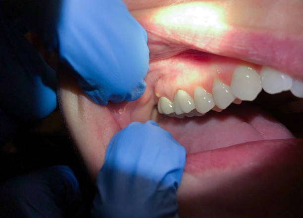Best Emergency Gum Treatment in Wilmington, OH