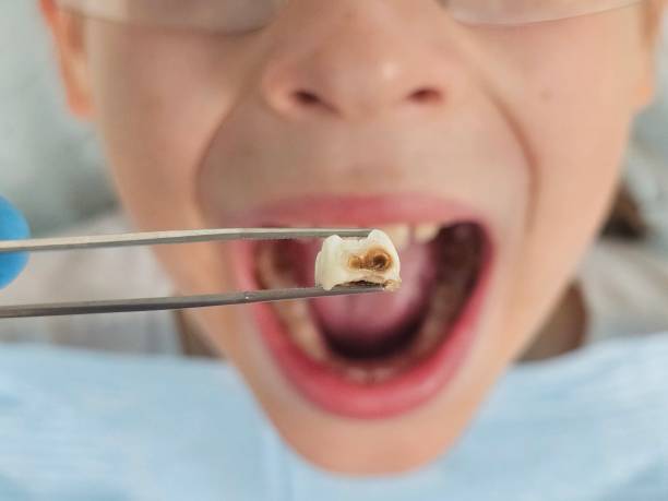 Best Emergency Treatment for Dental Infections or Abscesses in Wilmington, OH